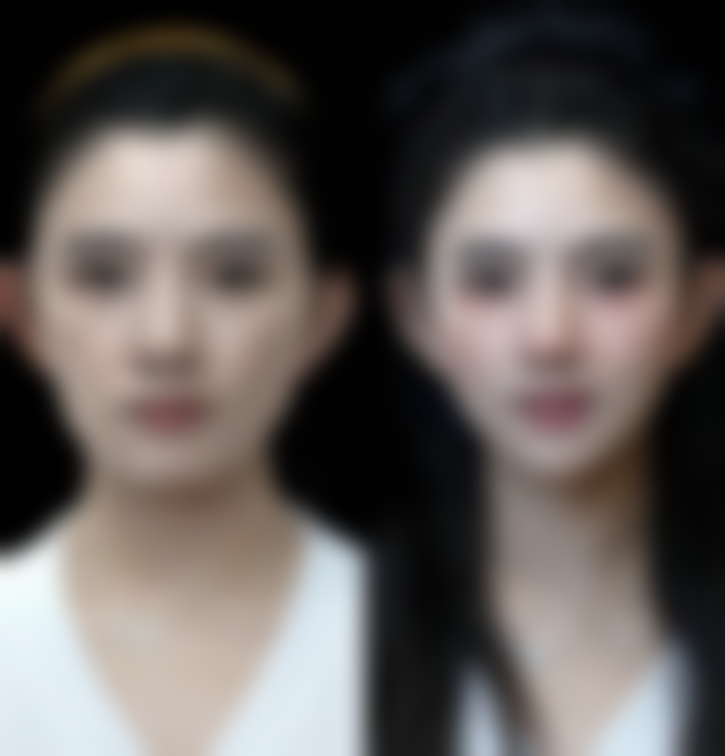 {全切双眼皮第13天可以洗脸了吗？术后13天能否化妆也有这些讲究！ 