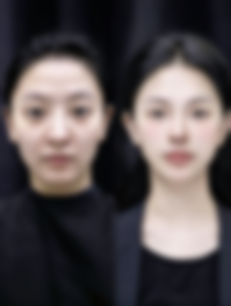 二、成熟期瘢痕管理：子宫切除的疤痕持续改善（术后 3 个月以后）