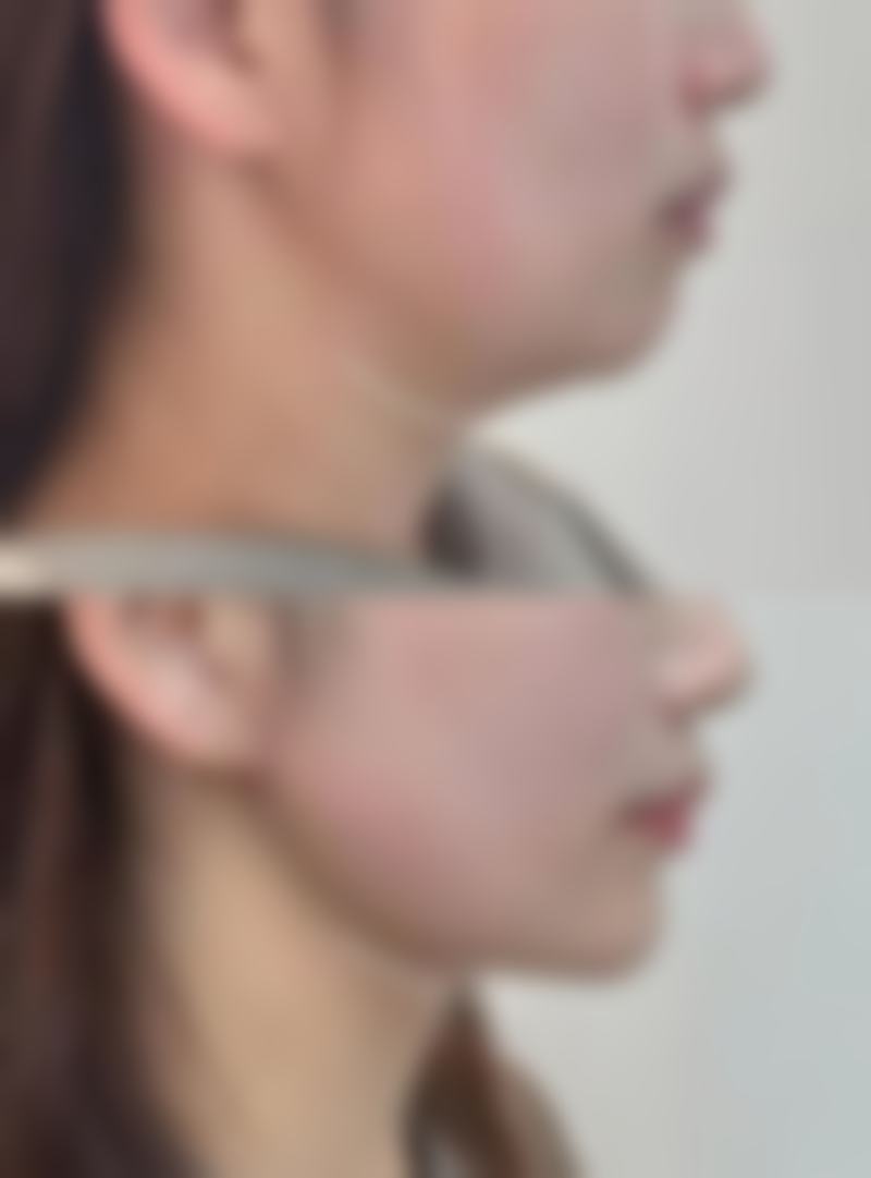 四、全切双眼皮术后13天能否化妆及讲究