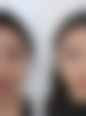 一、了解眼袋类型，选对祛眼袋方案