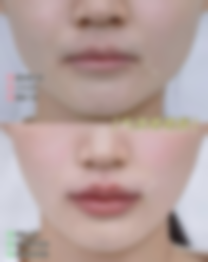 {如何去除疤痕的颜色和痕迹？多种专业方法及日常护理助你恢复光滑肌肤 