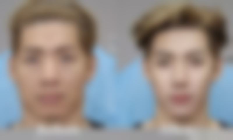 三、做双眼皮开眼角拆线后护理要点