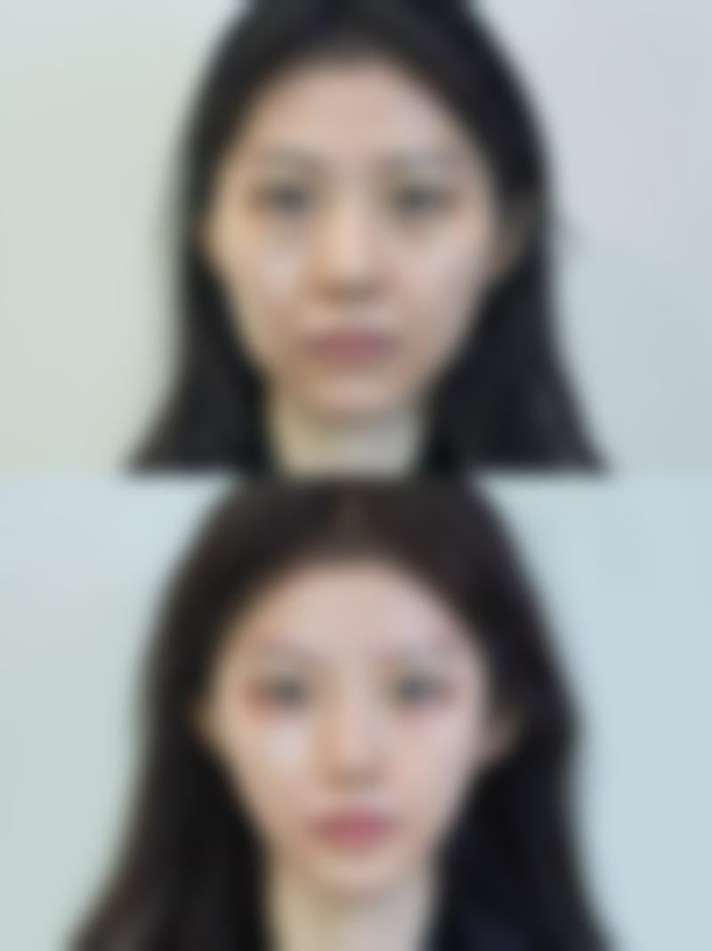 一、双眼皮后消肿的一般规律