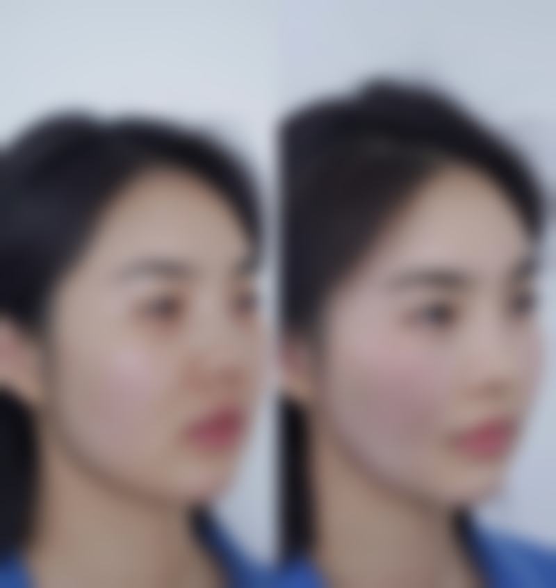 一、瘦脸针打一次多少个单位的基本情况