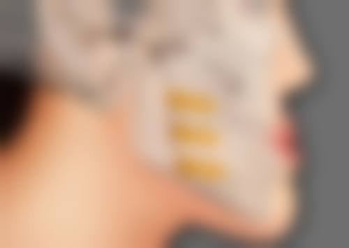 四、疤痕体质不适合点阵激光的替代治疗方案