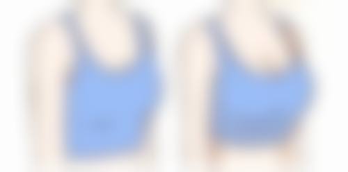 四、切开双眼皮的美学设计要点