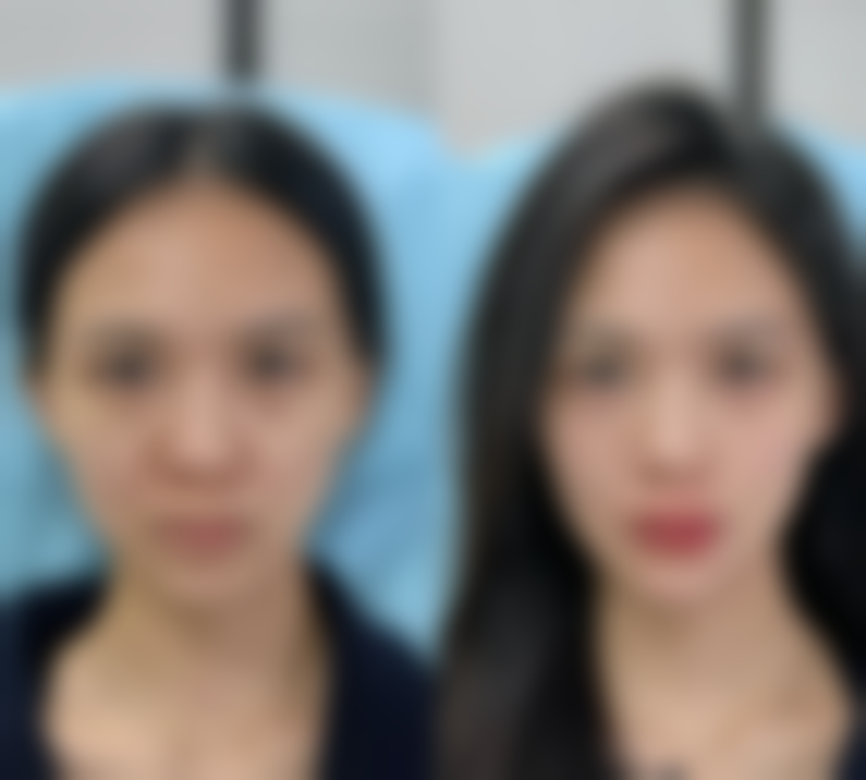 五、切开双眼皮的风险与术后修复