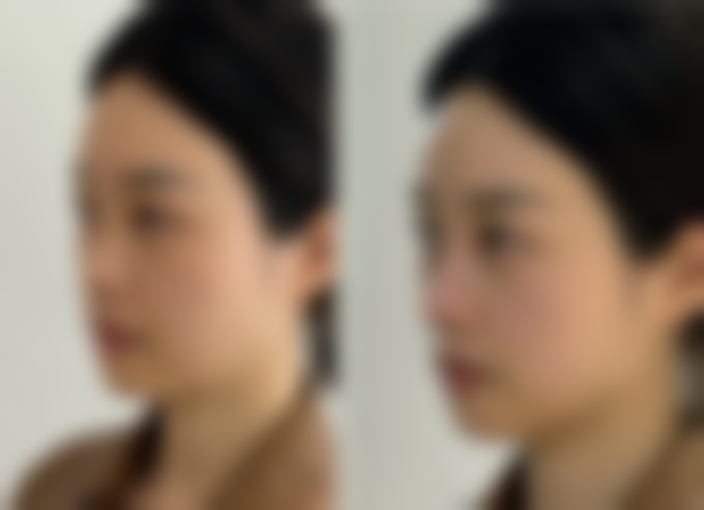 {有必要打瘦脸针吗？女生需考量面部成因、审美需求及健康状况再做决定 