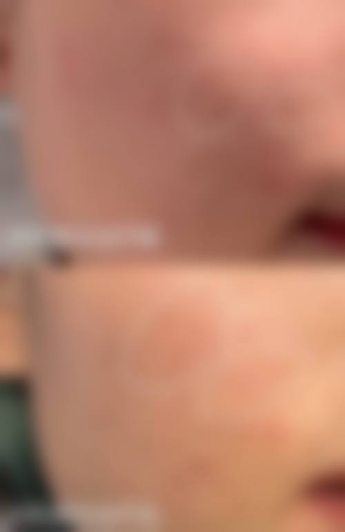 六、打瘦脸针安心吗?总结