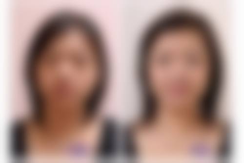 三、科学去除眼袋脂肪粒的方法