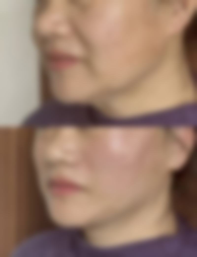 五、打瘦脸针的注意事项