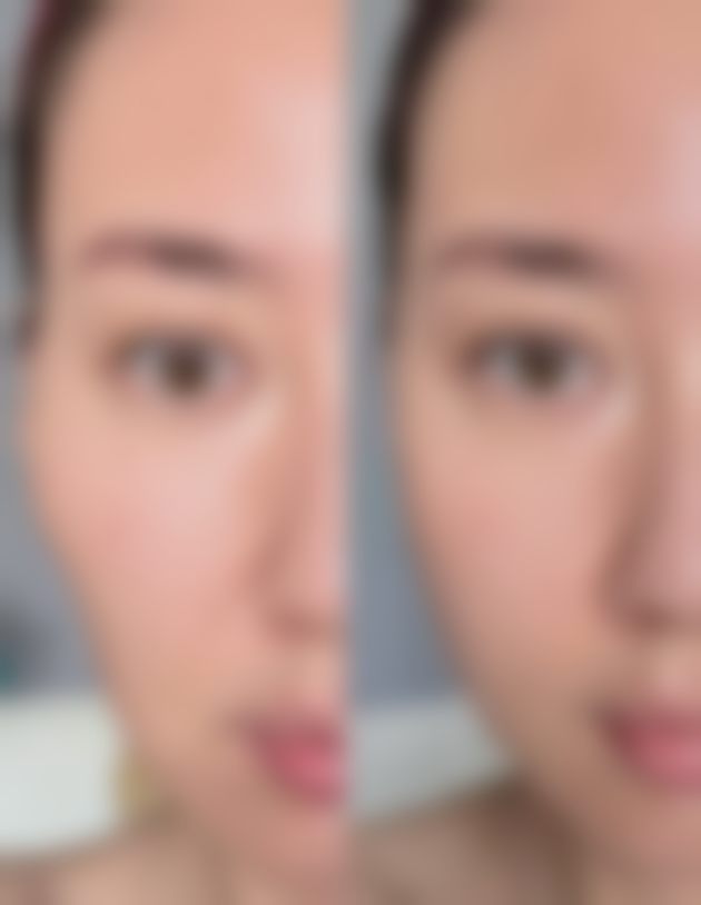 五、泪沟填充的注意事项