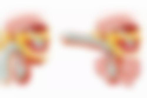 二、割双眼皮的修复阶段及注意事项