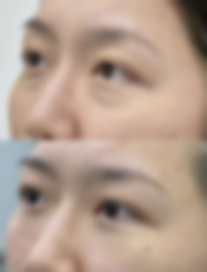 {哪种隆胸安全可靠？解析假体、自体脂肪及复合隆胸的安全性与适用人群