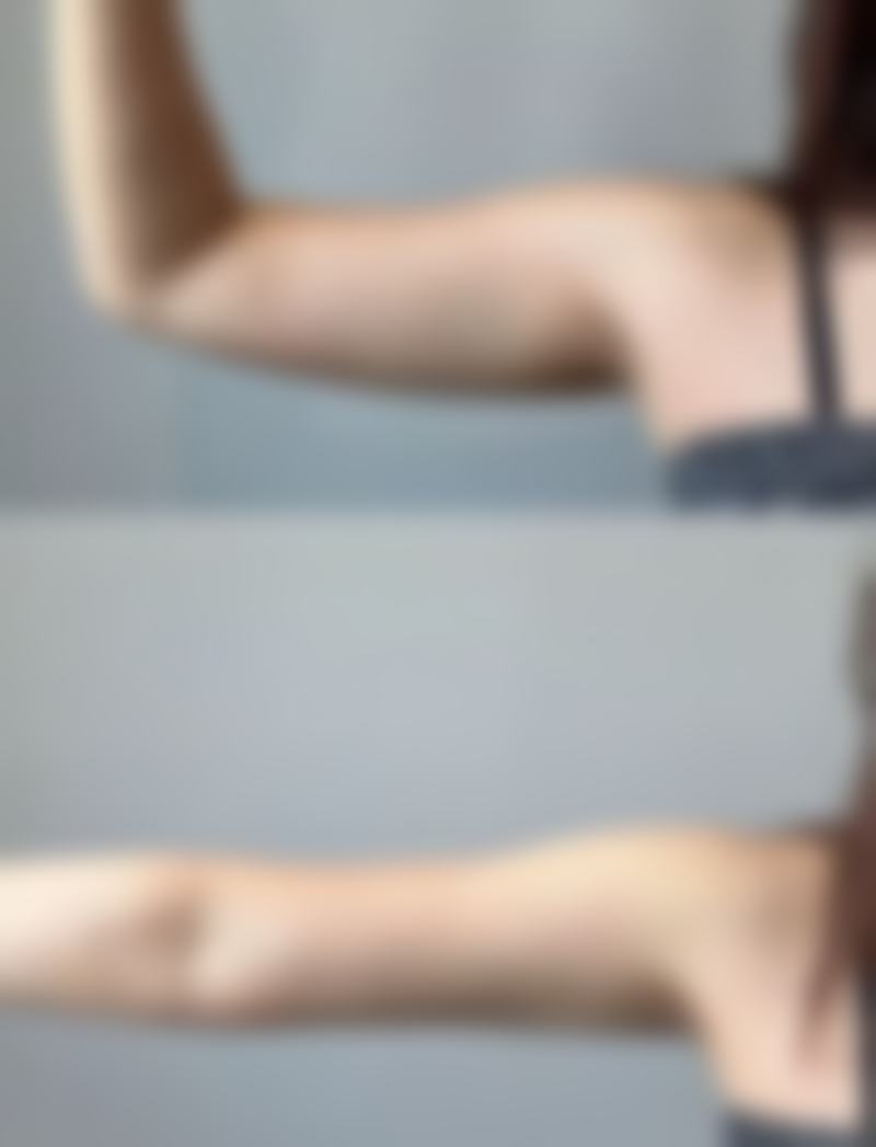 一、烫伤后红色疤痕形成原因