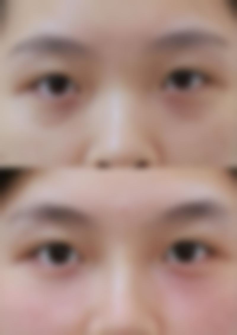 二、不同修复阶段抽烟的影响及建议