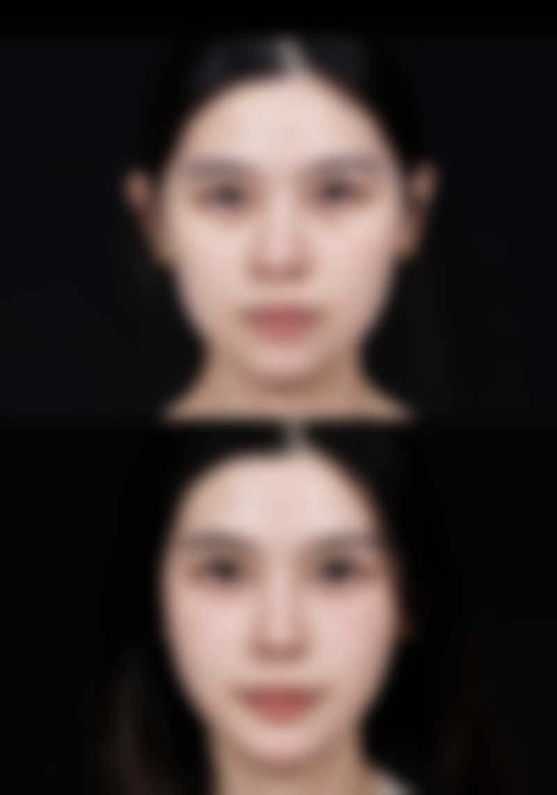 一、进口瘦脸针品牌大盘点