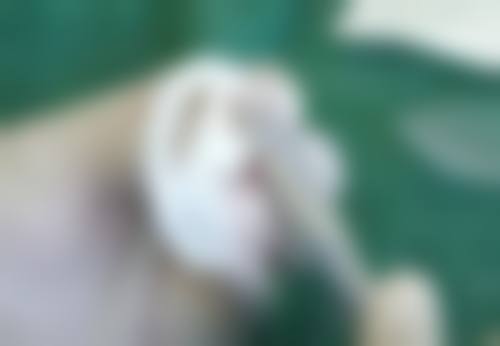 三、分型治疗烫伤疤痕