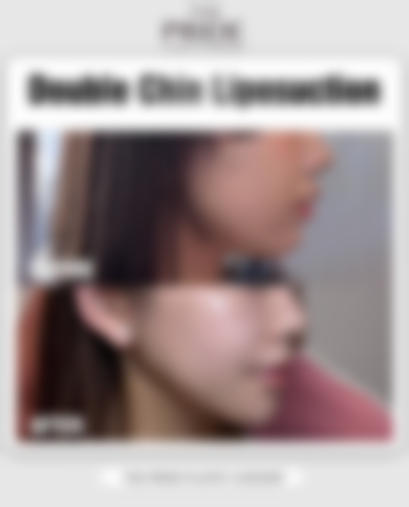 二、影响割双眼皮价格的因素