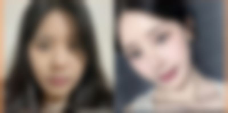 {皮肤烫伤疤痕怎么办？掌握这些小妙招，分阶段分型治疗助你有效祛疤 