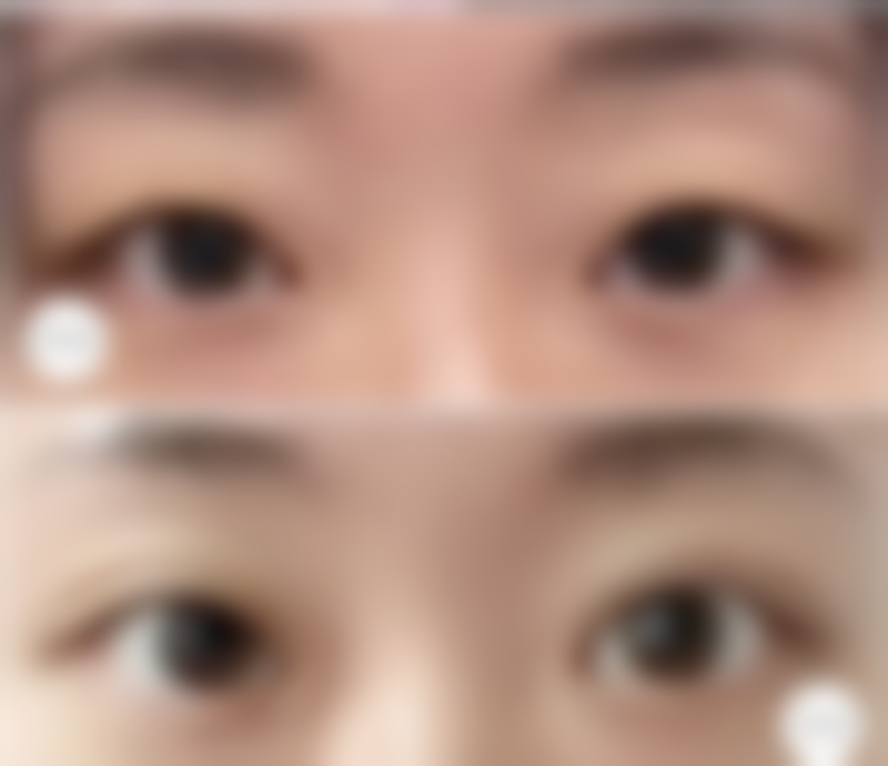 四、取出手术的多方面考量