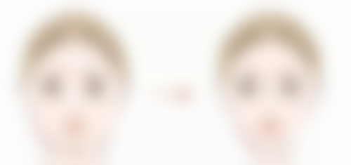 一、双眼皮埋线手术的基本情况