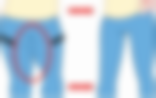 {双眼皮埋线危险吗?了解其可能存在的危害与后遗症，理性开启变美之旅 