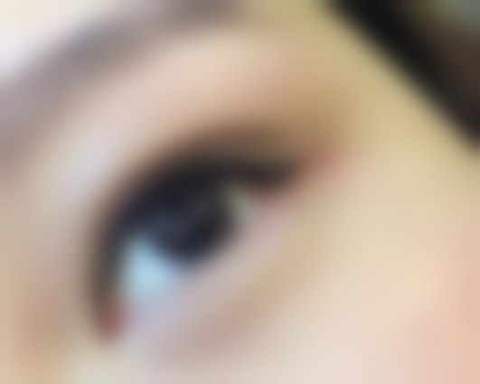 五、鼻子凹陷性疤痕治疗的注意事项