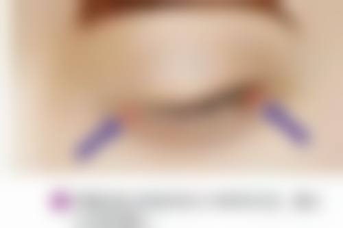 四、有必要做阴道紧缩术吗？决策前的关键步骤