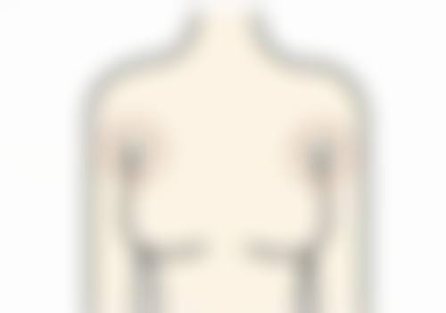 二、割完双眼皮四个月常见需修复的情况及实例