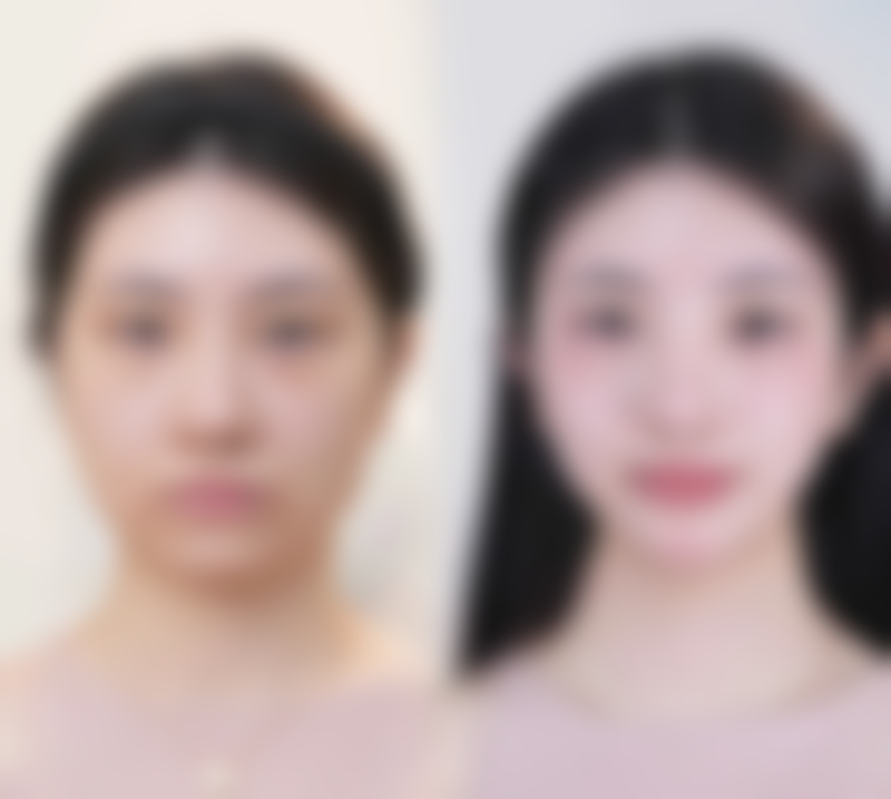 三、手术切除疤痕增生的禁忌或需谨慎的情况