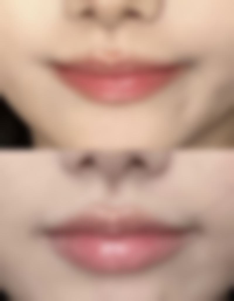 六、割完双眼皮四个月修复成效实例展示与分析