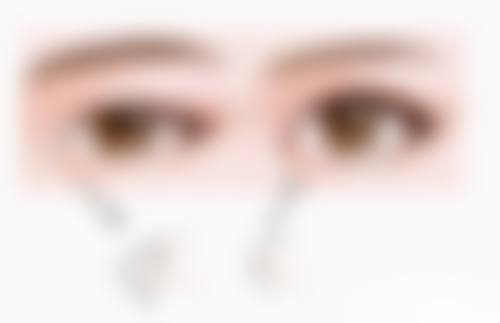 一、疤痕疙瘩的特点与治疗难点