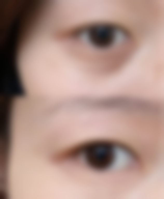 四、增生性疤痕的特点与危害