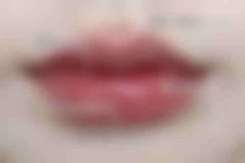 四、对待疤痕增生黑色素沉淀的正确心态