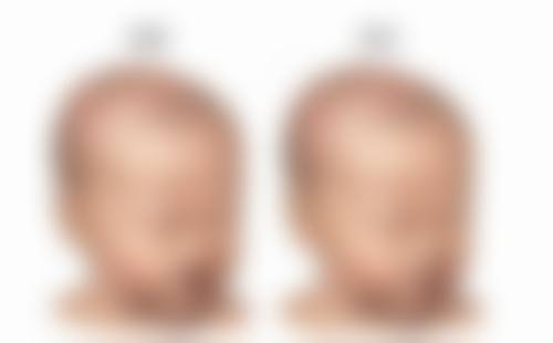 四、点痣的疤痕修复过程及注意事项