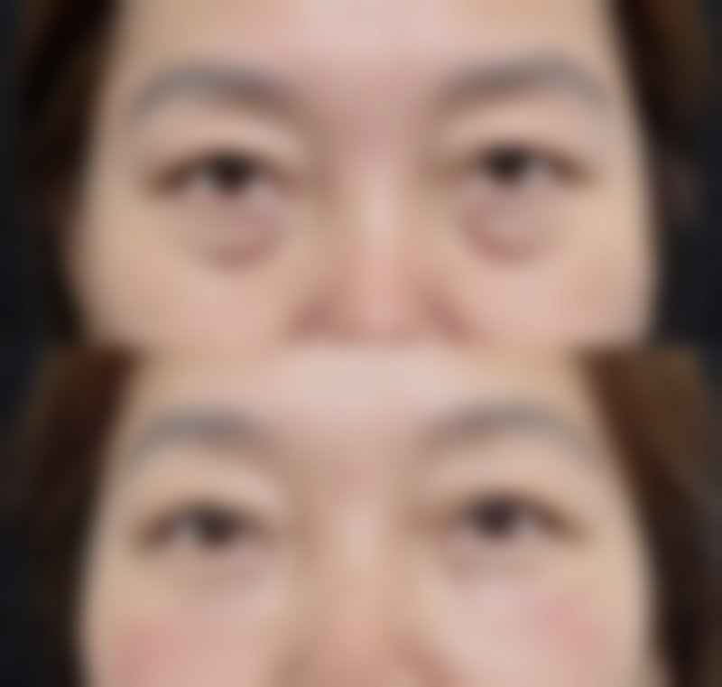 {点痣留下疤痕怎么祛？红色疤痕去除方法大揭秘，让肌肤重焕光彩！ 