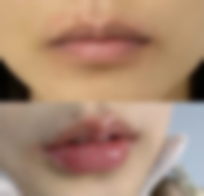 一、抽脂后过早泡温泉的风险