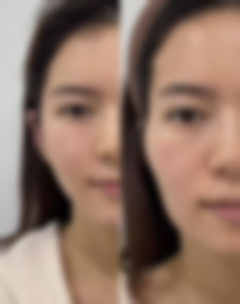 二、隆鼻后鼻头红的针对性解决方案