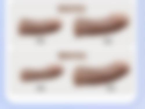 五、隆胸假体使用年限是多久?