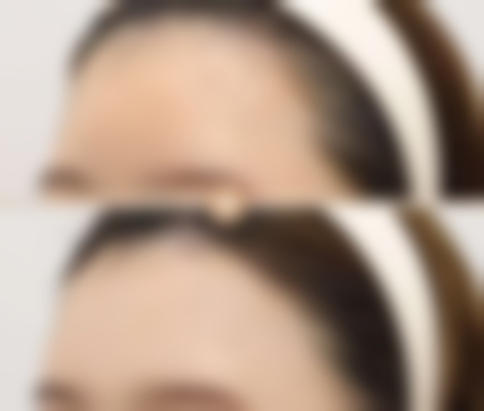 一、女生怎么去除眼袋之了解眼袋类型