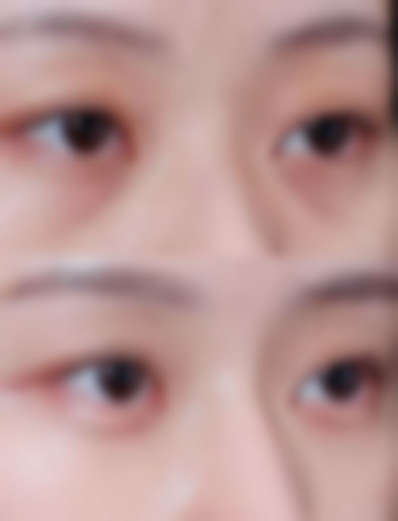 二、假体隆胸换大的麻烦吗?术前评估不可少