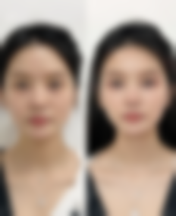 一、隆鼻一般能管多久:主流材料介绍