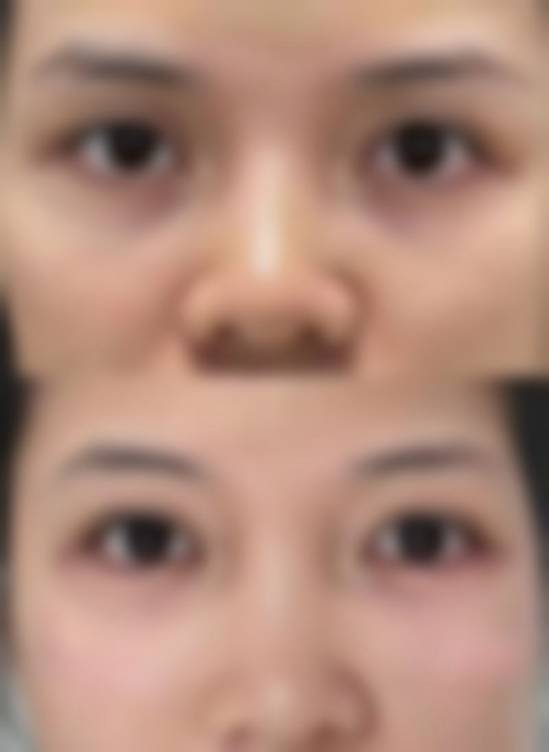 三、水光针除皱的临床成效及维持时间