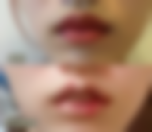 二、非手术方式