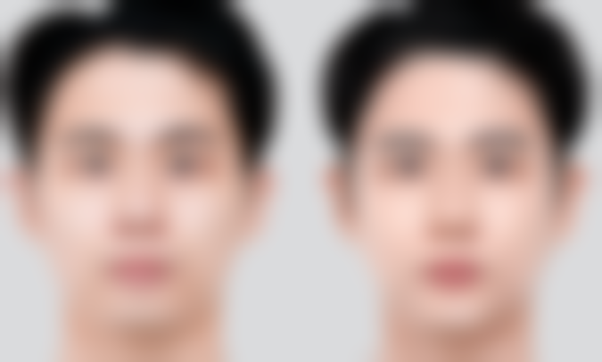 {脸上有疤痕能去吗？女生别焦虑，多种医美手段助你显著改善疤痕外观