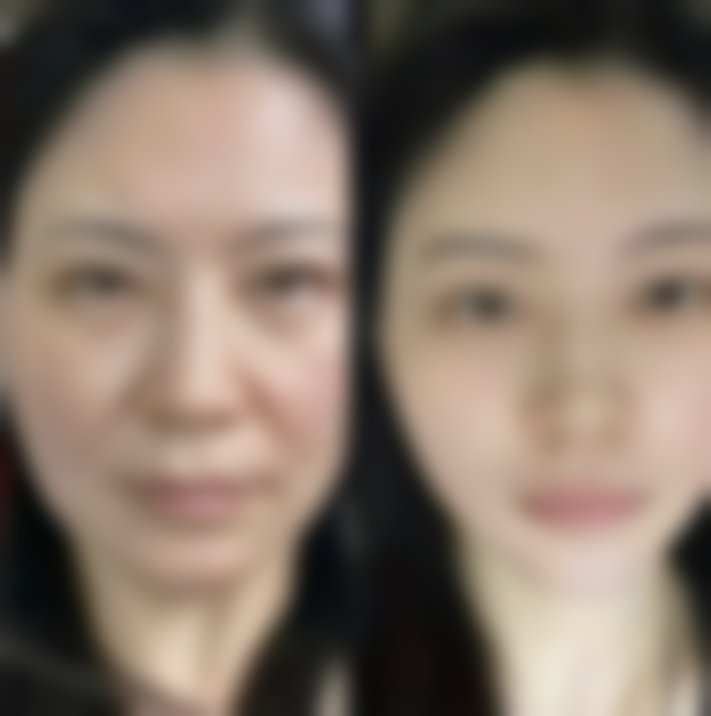 四、婴儿怎么看双眼皮之注意事项