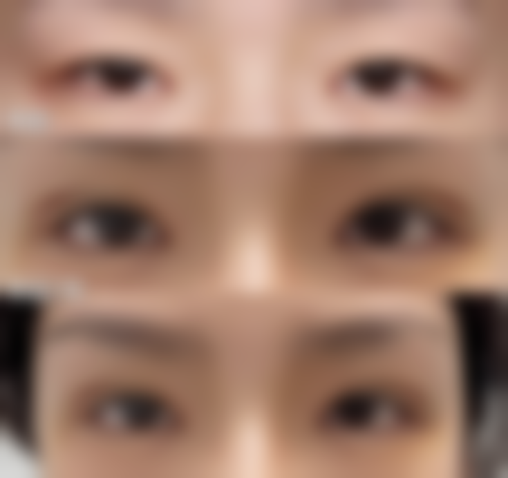 三、不同术式修复时间及同房建议