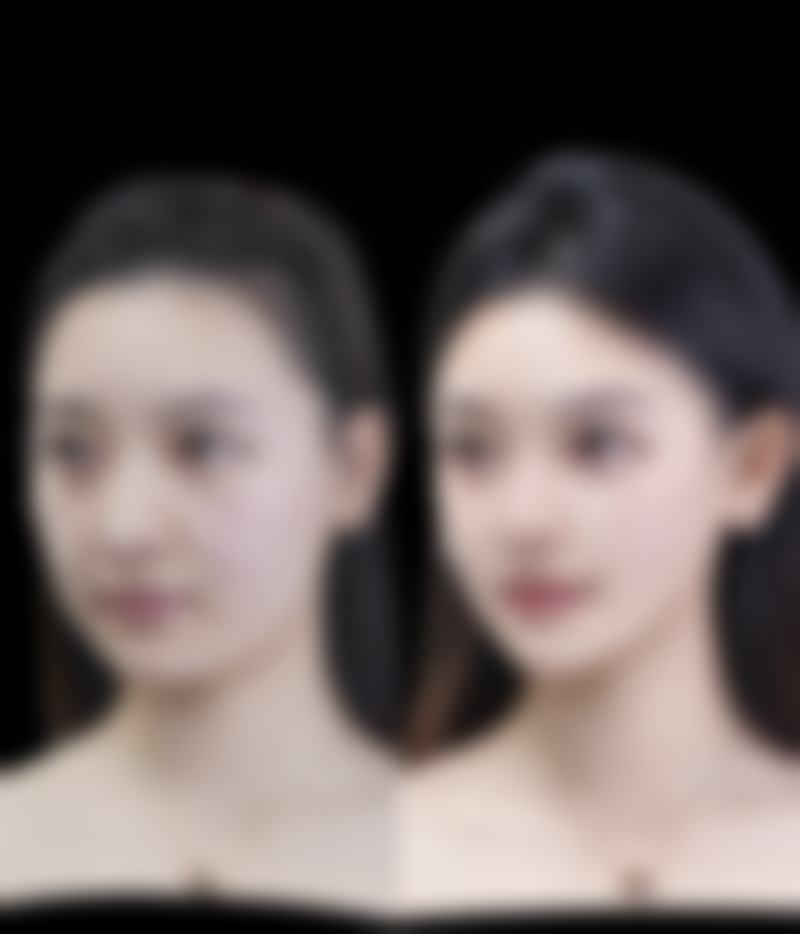 六、全切双眼皮窄了可以改宽吗：总结