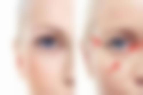 五、做双眼皮抽脂的术前准备和术后护理